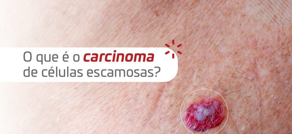 Cancer-Carcinoma_Banner-rbxxnzjkwz4eg4qt3fcc0f26buuwhf5w8vdplhgsqm